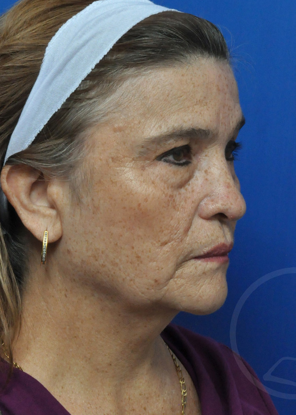 Plastic Surgery Before and After Pictures in Jacksonville, FL - Garcia Facial Plastic Surgery