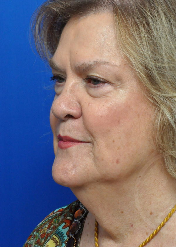 Plastic Surgery Before and After Pictures in Jacksonville, FL - Garcia Facial Plastic Surgery