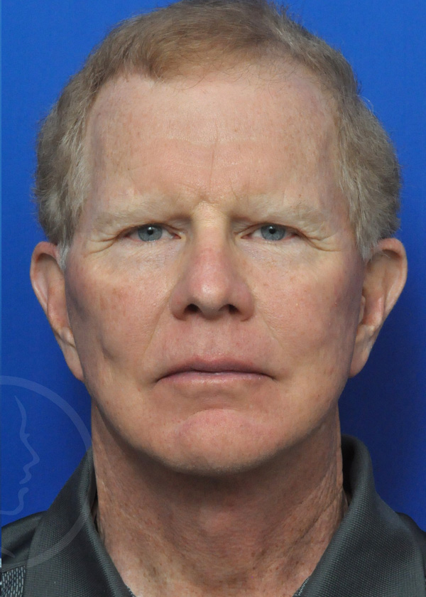 Plastic Surgery Before and After Pictures in Jacksonville, FL - Garcia Facial Plastic Surgery