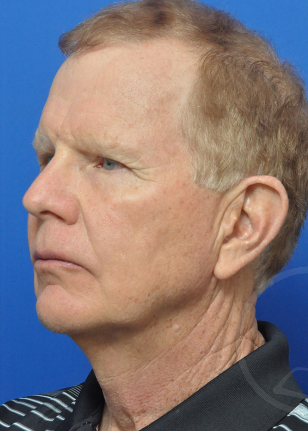 Plastic Surgery Before and After Pictures in Jacksonville, FL - Garcia Facial Plastic Surgery