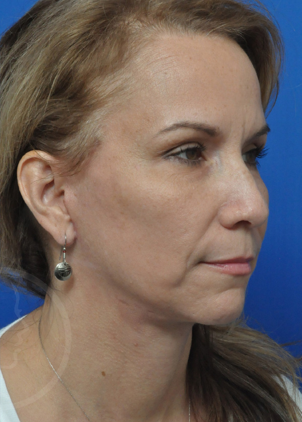 Plastic Surgery Before and After Pictures in Jacksonville, FL - Garcia Facial Plastic Surgery