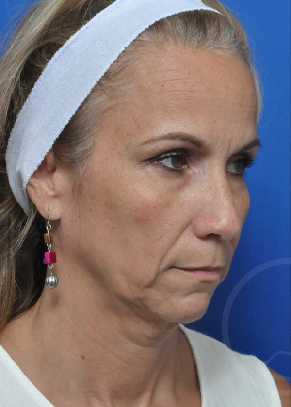 Plastic Surgery Before and After Pictures in Jacksonville, FL - Garcia Facial Plastic Surgery