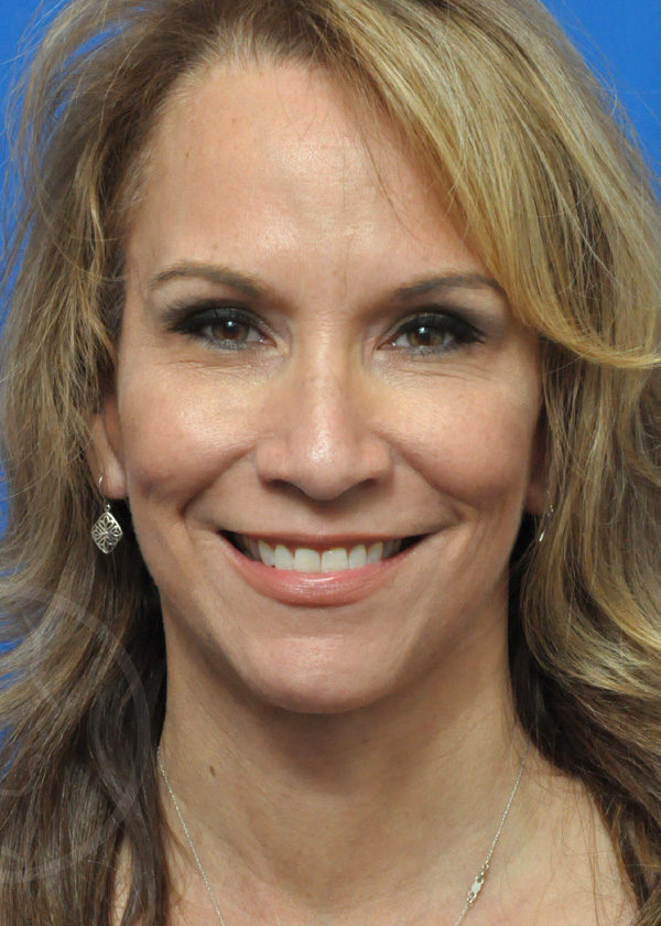 Plastic Surgery Before and After Pictures in Jacksonville, FL - Garcia Facial Plastic Surgery