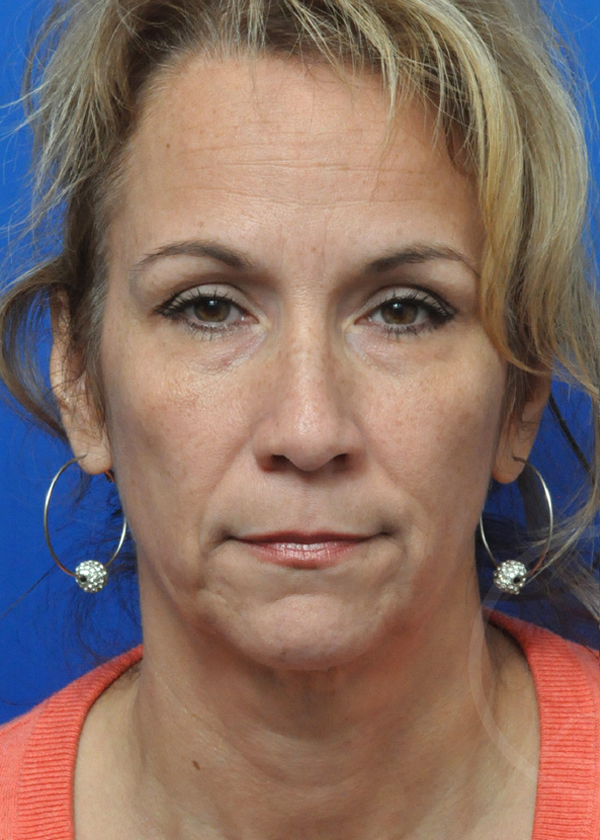 Plastic Surgery Before and After Pictures in Jacksonville, FL - Garcia Facial Plastic Surgery