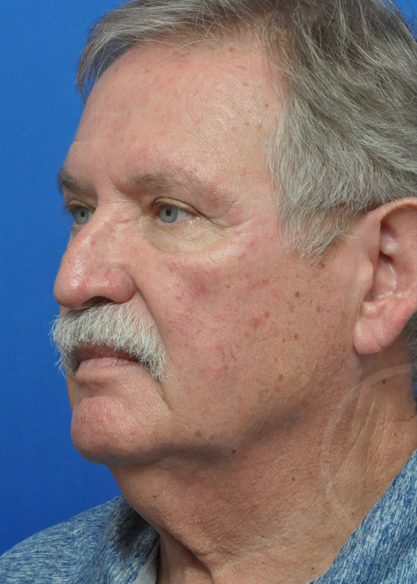 Plastic Surgery Before and After Pictures in Jacksonville, FL - Garcia Facial Plastic Surgery