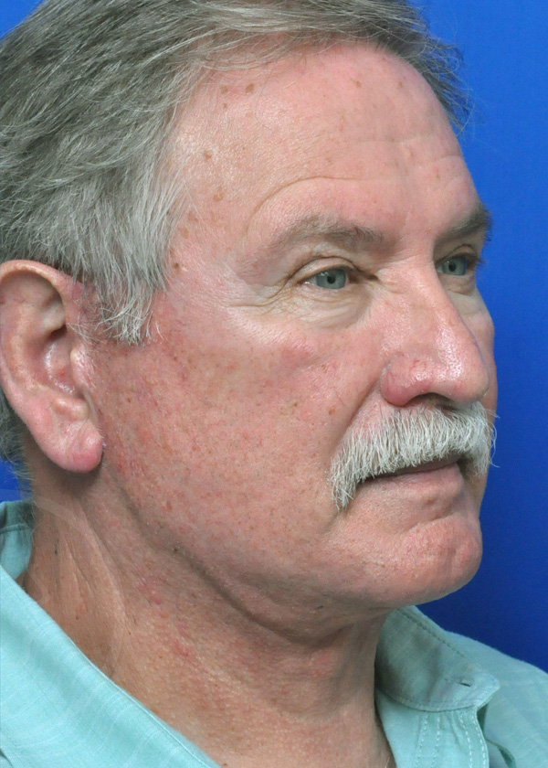 Plastic Surgery Before and After Pictures in Jacksonville, FL - Garcia Facial Plastic Surgery