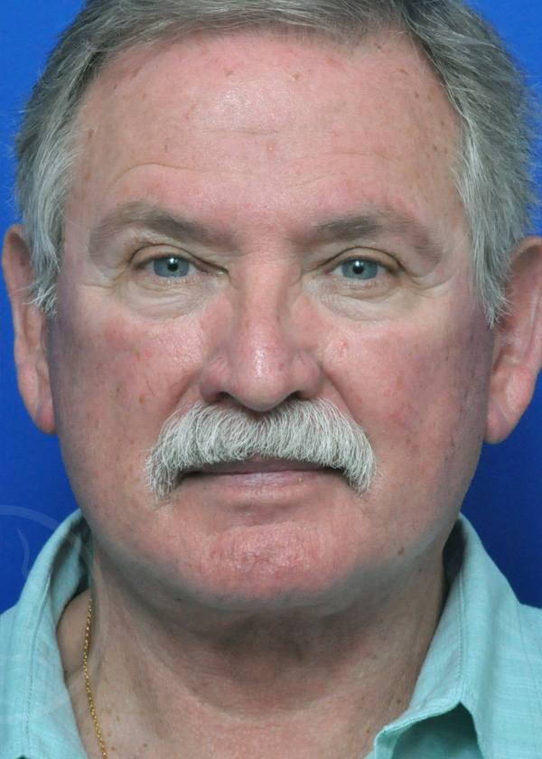 Plastic Surgery Before and After Pictures in Jacksonville, FL - Garcia Facial Plastic Surgery