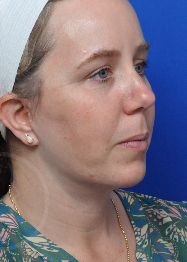 Plastic Surgery Before and After Pictures in Jacksonville, FL - Garcia Facial Plastic Surgery