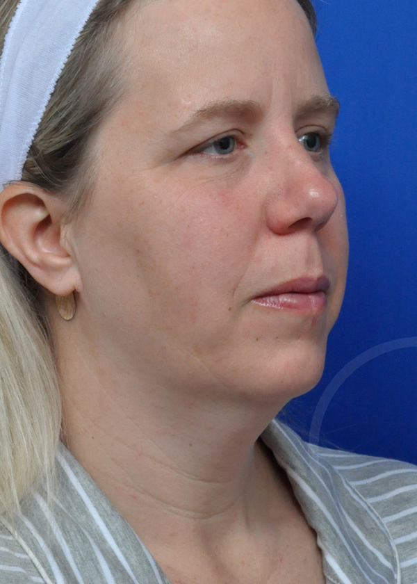 Plastic Surgery Before and After Pictures in Jacksonville, FL - Garcia Facial Plastic Surgery