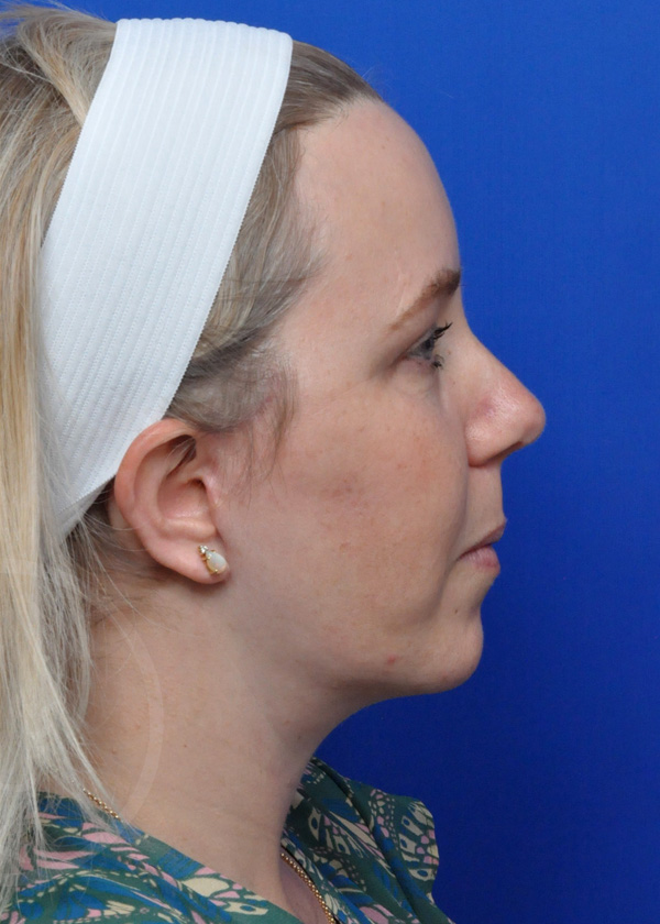 Plastic Surgery Before and After Pictures in Jacksonville, FL - Garcia Facial Plastic Surgery