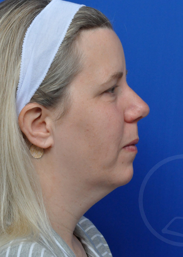 Plastic Surgery Before and After Pictures in Jacksonville, FL - Garcia Facial Plastic Surgery