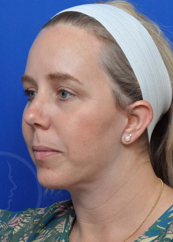 Plastic Surgery Before and After Pictures in Jacksonville, FL - Garcia Facial Plastic Surgery