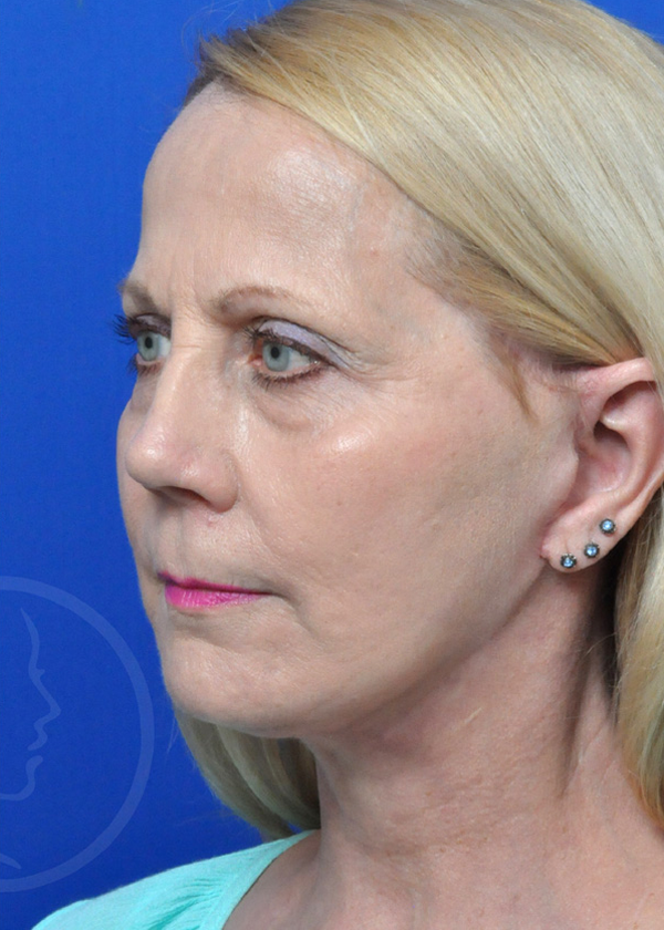 Plastic Surgery Before and After Pictures in Jacksonville, FL - Garcia Facial Plastic Surgery