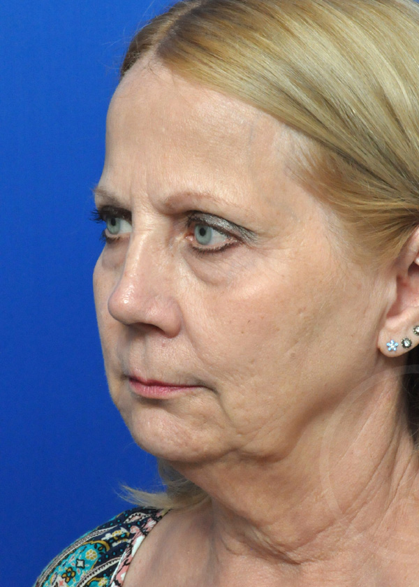 Plastic Surgery Before and After Pictures in Jacksonville, FL - Garcia Facial Plastic Surgery
