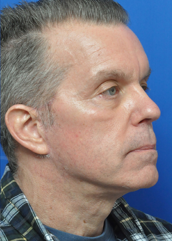 Plastic Surgery Before and After Pictures in Jacksonville, FL - Garcia Facial Plastic Surgery