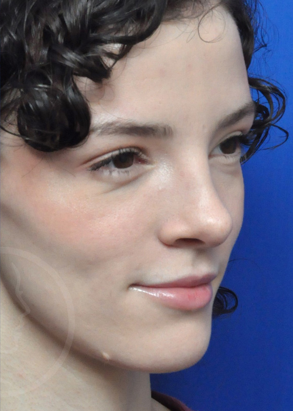 Plastic Surgery Before and After Pictures in Jacksonville, FL - Garcia Facial Plastic Surgery