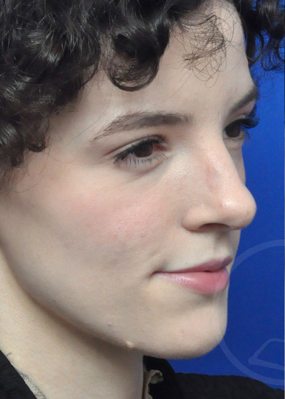 Plastic Surgery Before and After Pictures in Jacksonville, FL - Garcia Facial Plastic Surgery