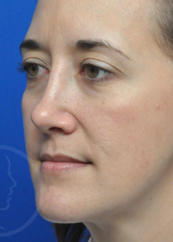 Plastic Surgery Before and After Pictures in Jacksonville, FL - Garcia Facial Plastic Surgery