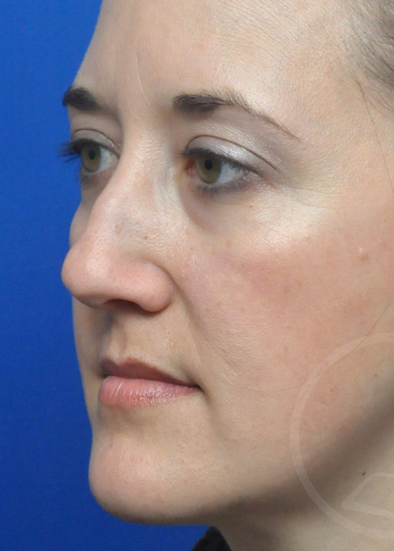 Plastic Surgery Before and After Pictures in Jacksonville, FL - Garcia Facial Plastic Surgery