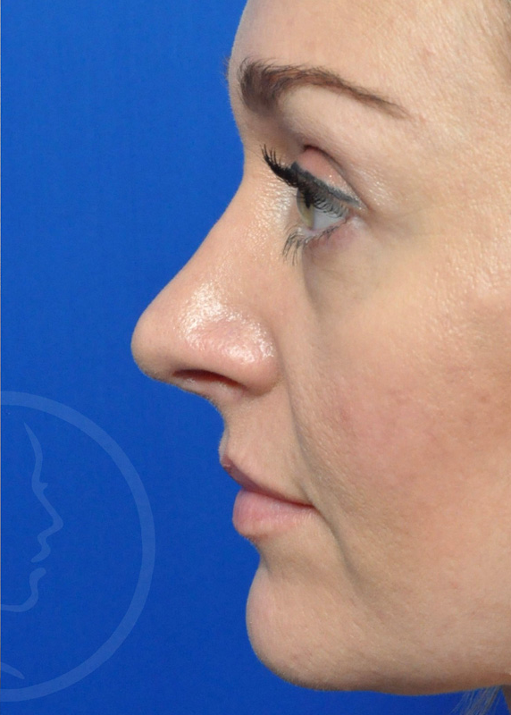 Plastic Surgery Before and After Pictures in Jacksonville, FL - Garcia Facial Plastic Surgery