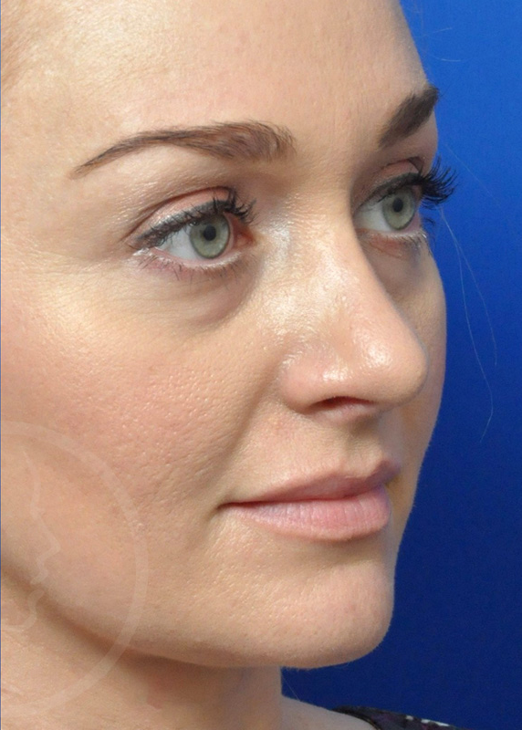 Plastic Surgery Before and After Pictures in Jacksonville, FL - Garcia Facial Plastic Surgery