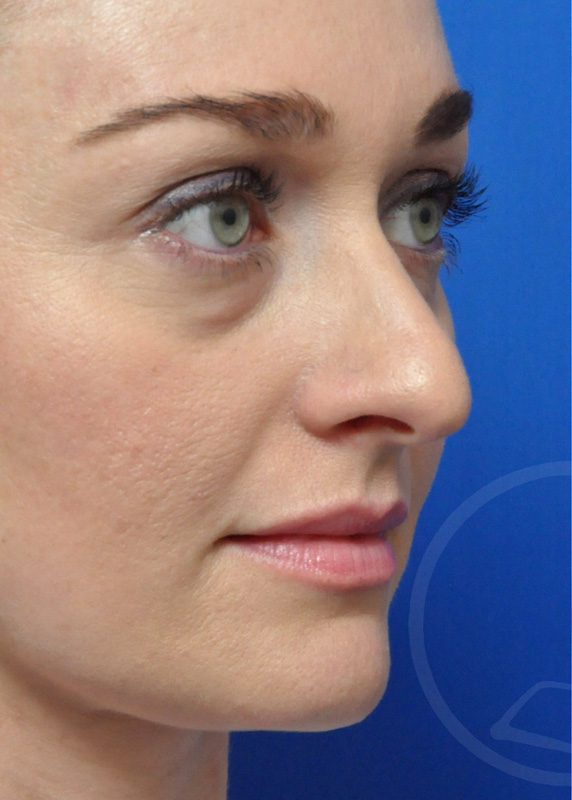 Plastic Surgery Before and After Pictures in Jacksonville, FL - Garcia Facial Plastic Surgery