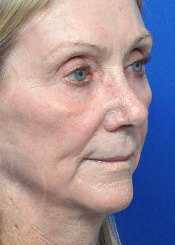 Plastic Surgery Before and After Pictures in Jacksonville, FL - Garcia Facial Plastic Surgery