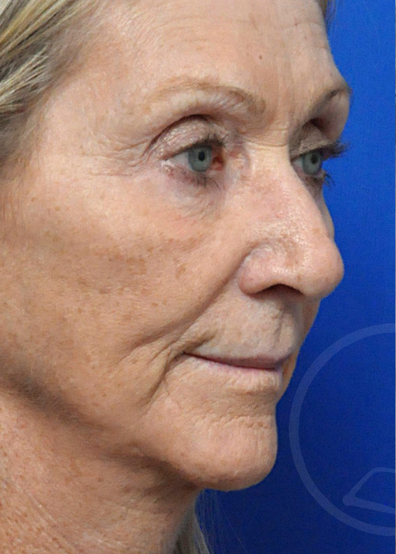 Plastic Surgery Before and After Pictures in Jacksonville, FL - Garcia Facial Plastic Surgery