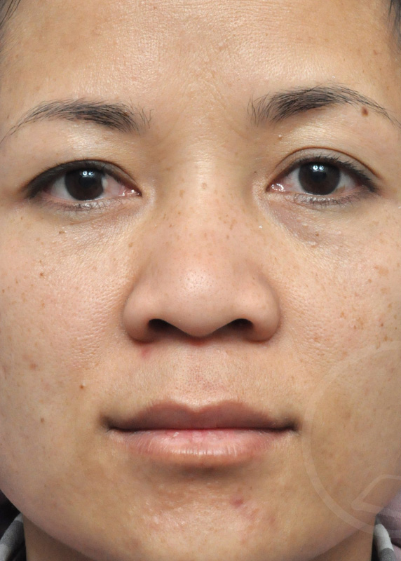 Plastic Surgery Before and After Pictures in Jacksonville, FL - Garcia Facial Plastic Surgery