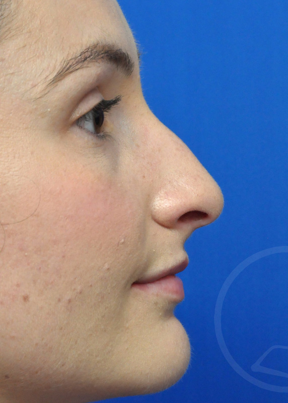 Plastic Surgery Before and After Pictures in Jacksonville, FL - Garcia Facial Plastic Surgery