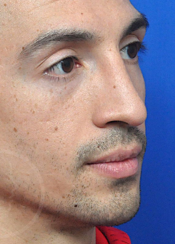 Plastic Surgery Before and After Pictures in Jacksonville, FL - Garcia Facial Plastic Surgery