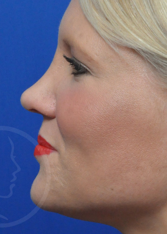 Plastic Surgery Before and After Pictures in Jacksonville, FL - Garcia Facial Plastic Surgery