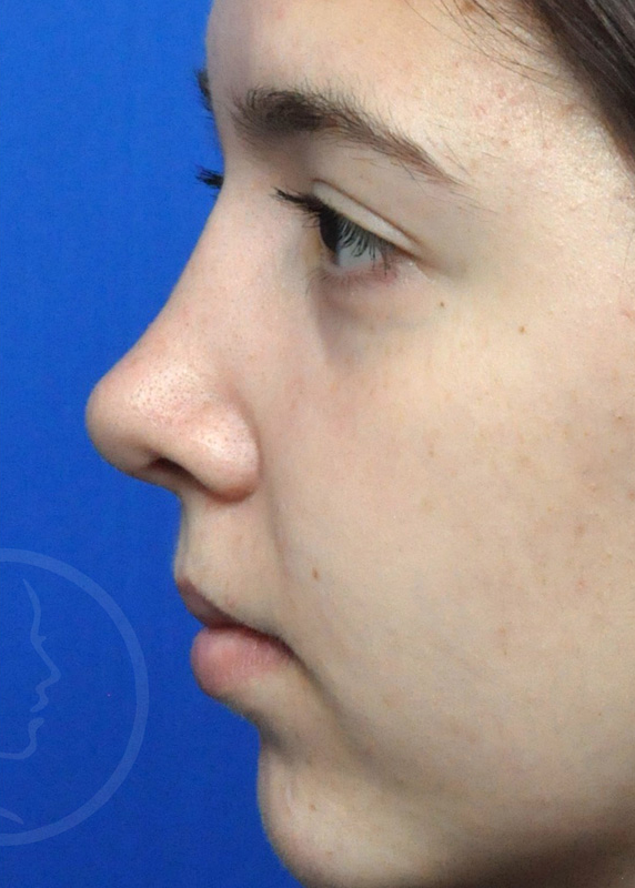 Plastic Surgery Before and After Pictures in Jacksonville, FL - Garcia Facial Plastic Surgery