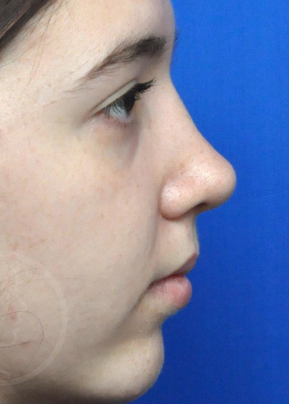 Plastic Surgery Before and After Pictures in Jacksonville, FL - Garcia Facial Plastic Surgery