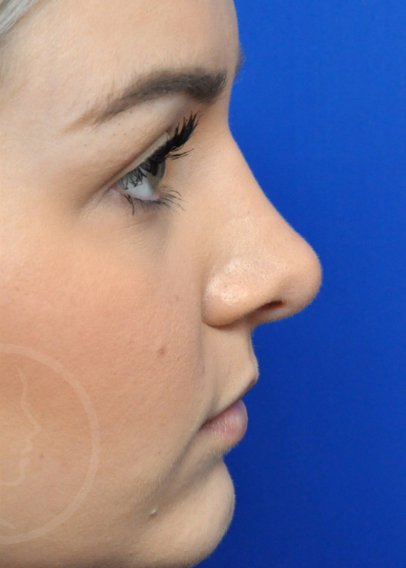 Plastic Surgery Before and After Pictures in Jacksonville, FL - Garcia Facial Plastic Surgery