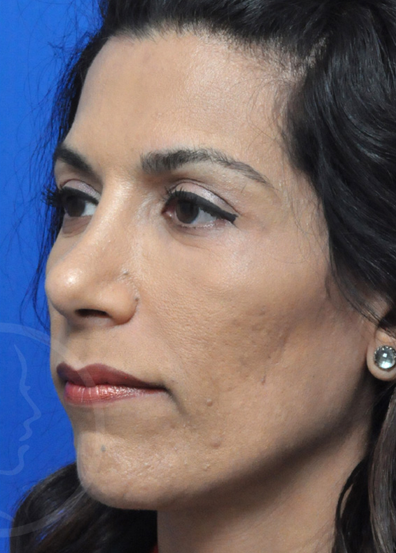 Plastic Surgery Before and After Pictures in Jacksonville, FL - Garcia Facial Plastic Surgery