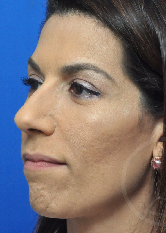 Plastic Surgery Before and After Pictures in Jacksonville, FL - Garcia Facial Plastic Surgery