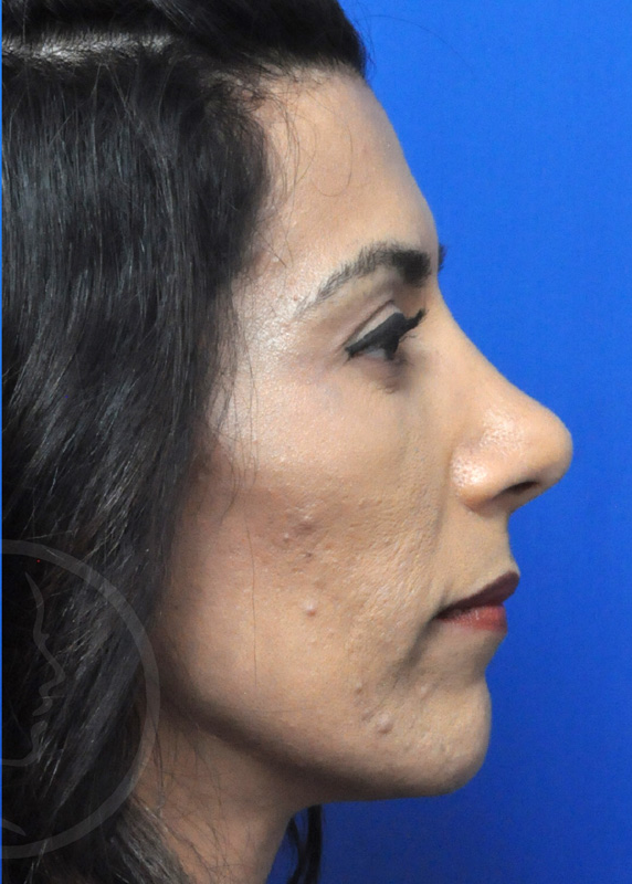 Plastic Surgery Before and After Pictures in Jacksonville, FL - Garcia Facial Plastic Surgery