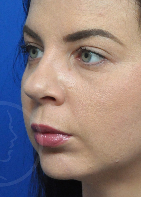 Plastic Surgery Before and After Pictures in Jacksonville, FL - Garcia Facial Plastic Surgery