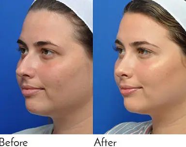 Rhinoplasty Journeys - Garcia Facial Plastic Surgery