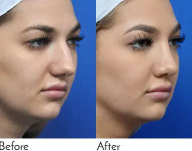 Rhinoplasty Journeys - Garcia Facial Plastic Surgery