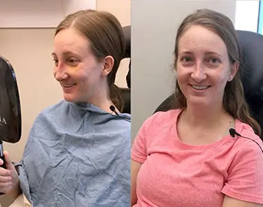 Rhinoplasty Journeys - Garcia Facial Plastic Surgery