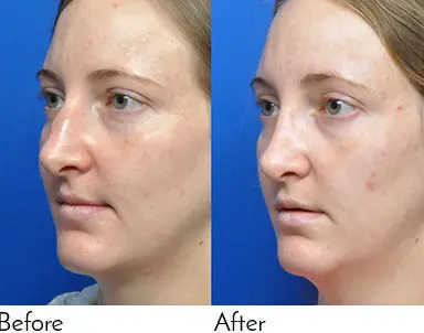 Rhinoplasty Journeys - Garcia Facial Plastic Surgery