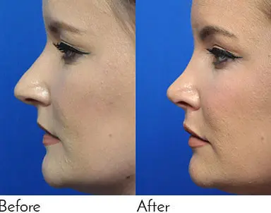 Rhinoplasty Journeys - Garcia Facial Plastic Surgery
