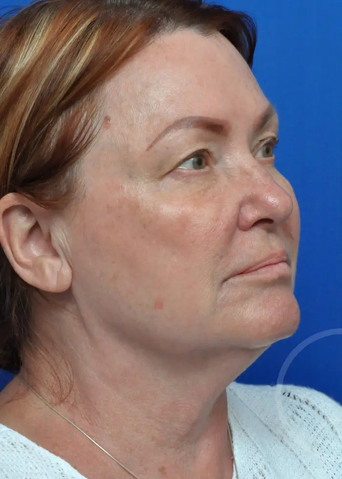 Plastic Surgery Before and After Pictures in Jacksonville, FL - Garcia Facial Plastic Surgery