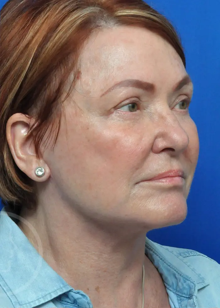 Plastic Surgery Before and After Pictures in Jacksonville, FL - Garcia Facial Plastic Surgery