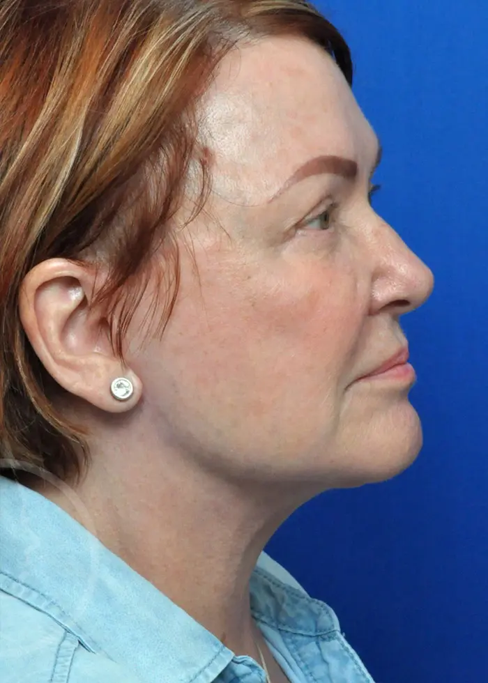 Plastic Surgery Before and After Pictures in Jacksonville, FL - Garcia Facial Plastic Surgery