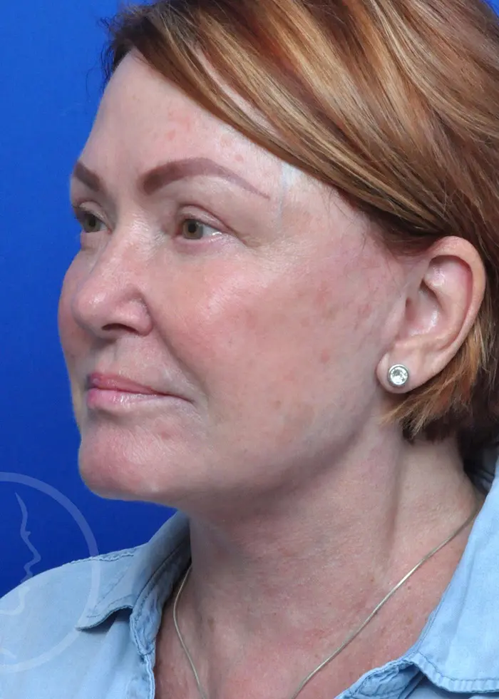 Plastic Surgery Before and After Pictures in Jacksonville, FL - Garcia Facial Plastic Surgery