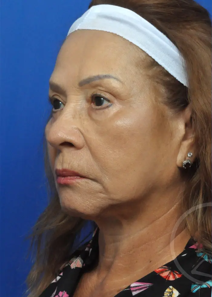 Plastic Surgery Before and After Pictures in Jacksonville, FL - Garcia Facial Plastic Surgery