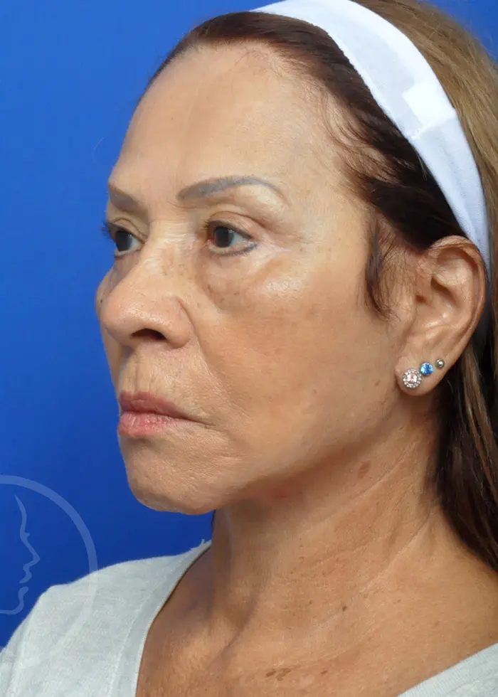 Plastic Surgery Before and After Pictures in Jacksonville, FL - Garcia Facial Plastic Surgery